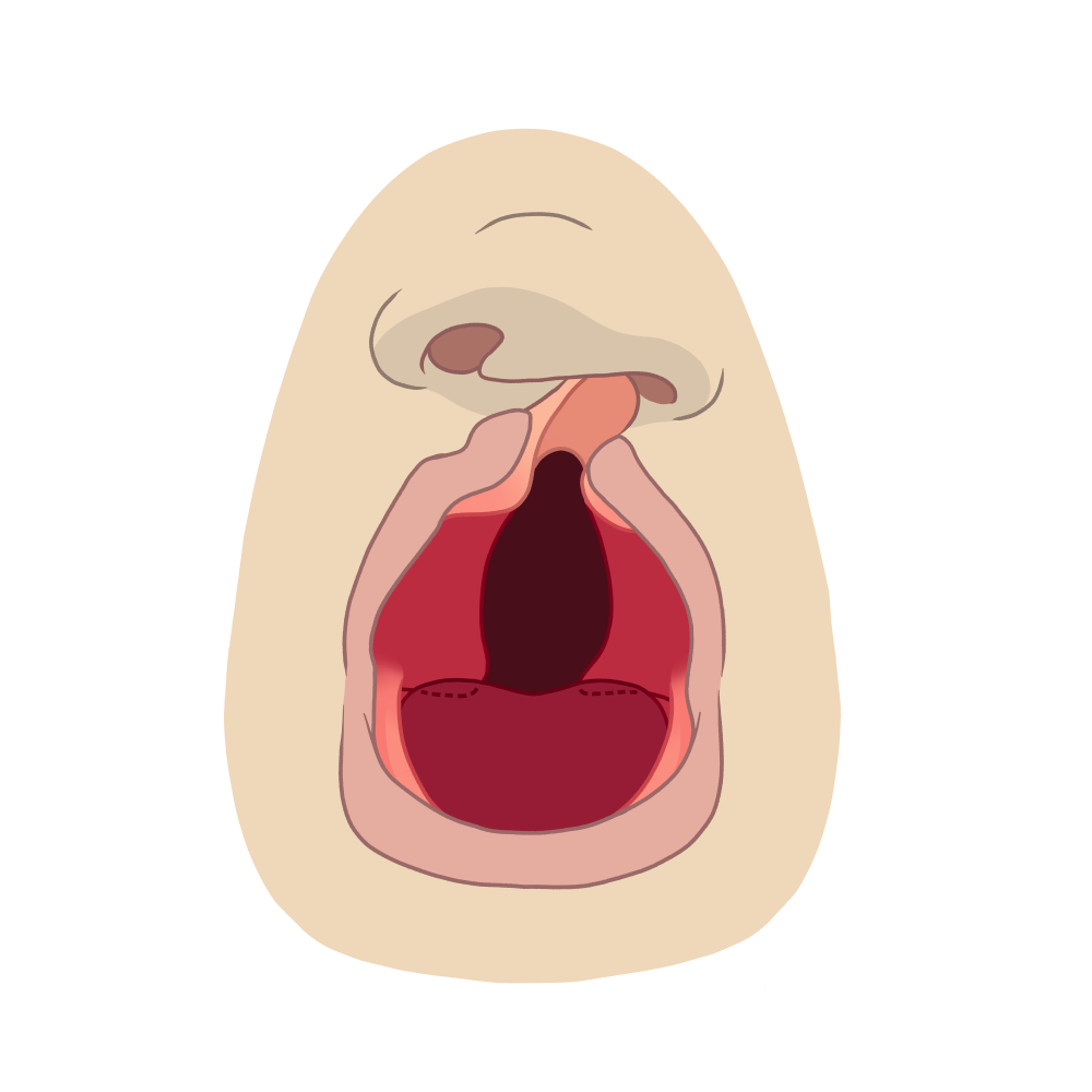 13 fente labiopalatine bouche