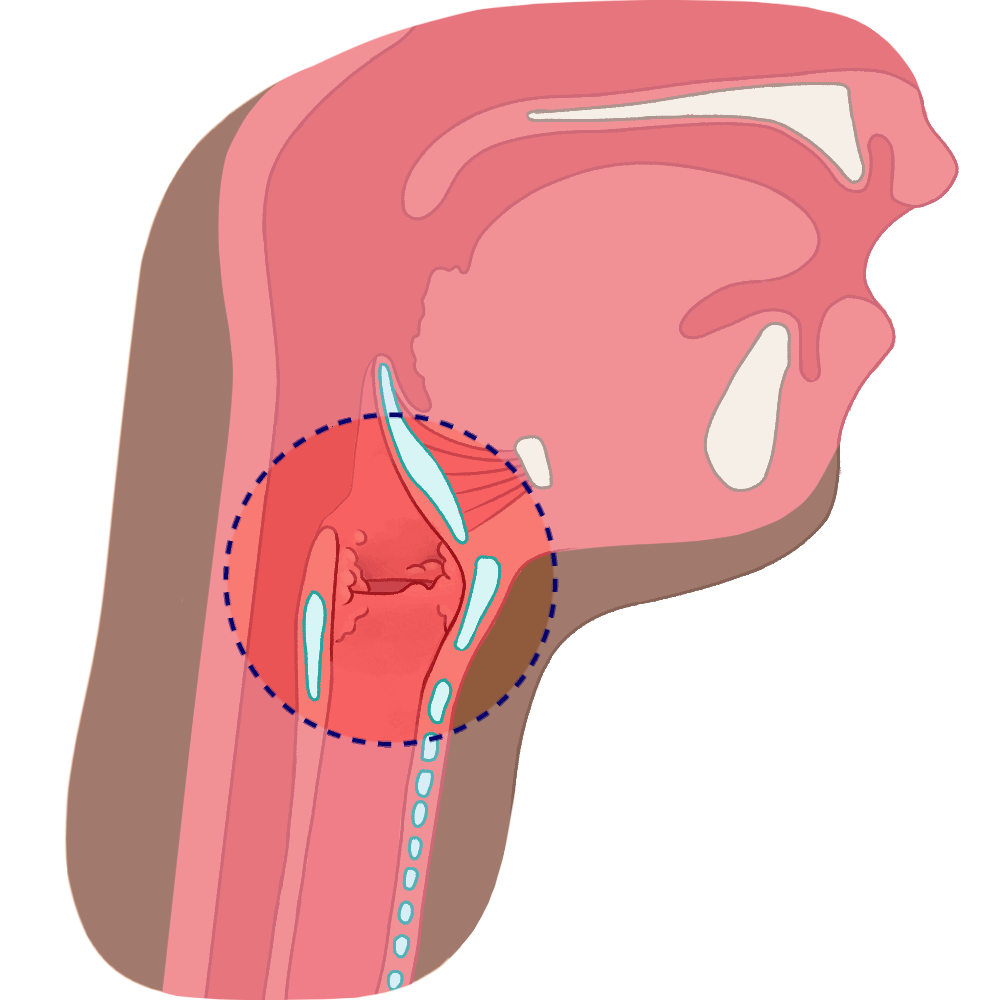 Pathologies des Cordes Vocales-Dysphonie 