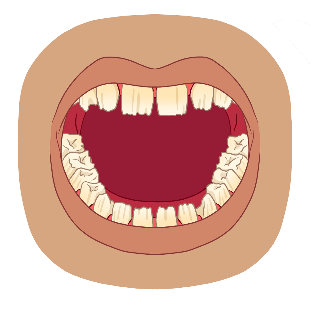 25 AI hypoplasique bouche