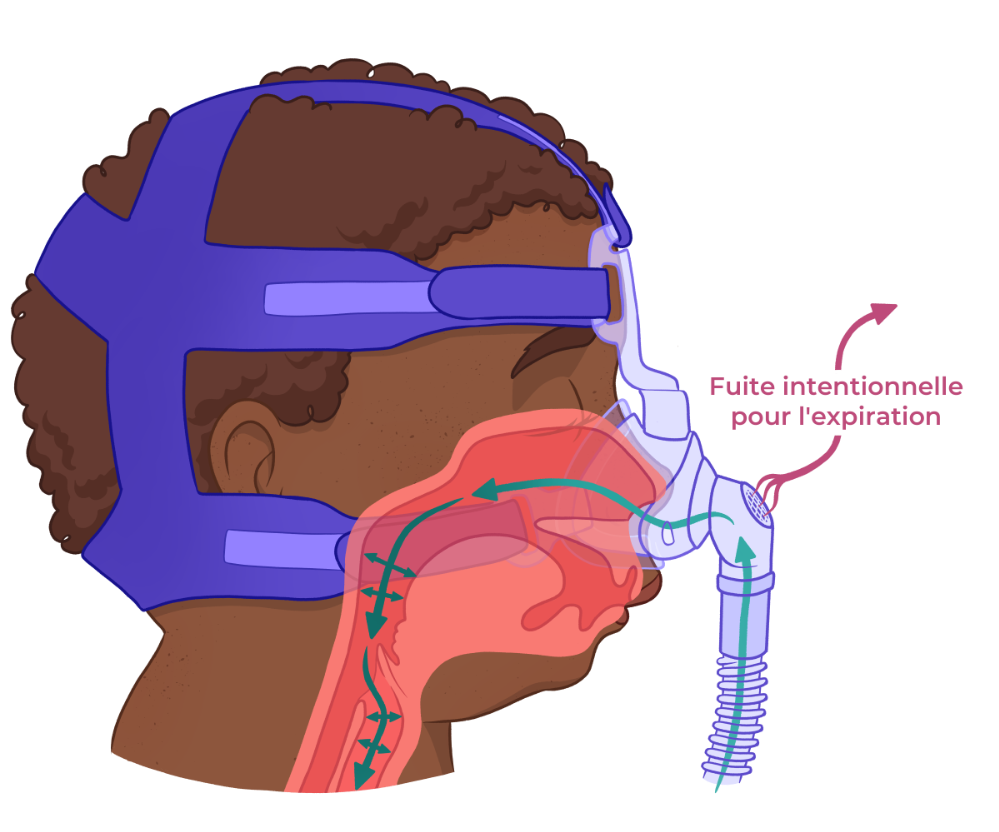 36 ventilation non invasive 2