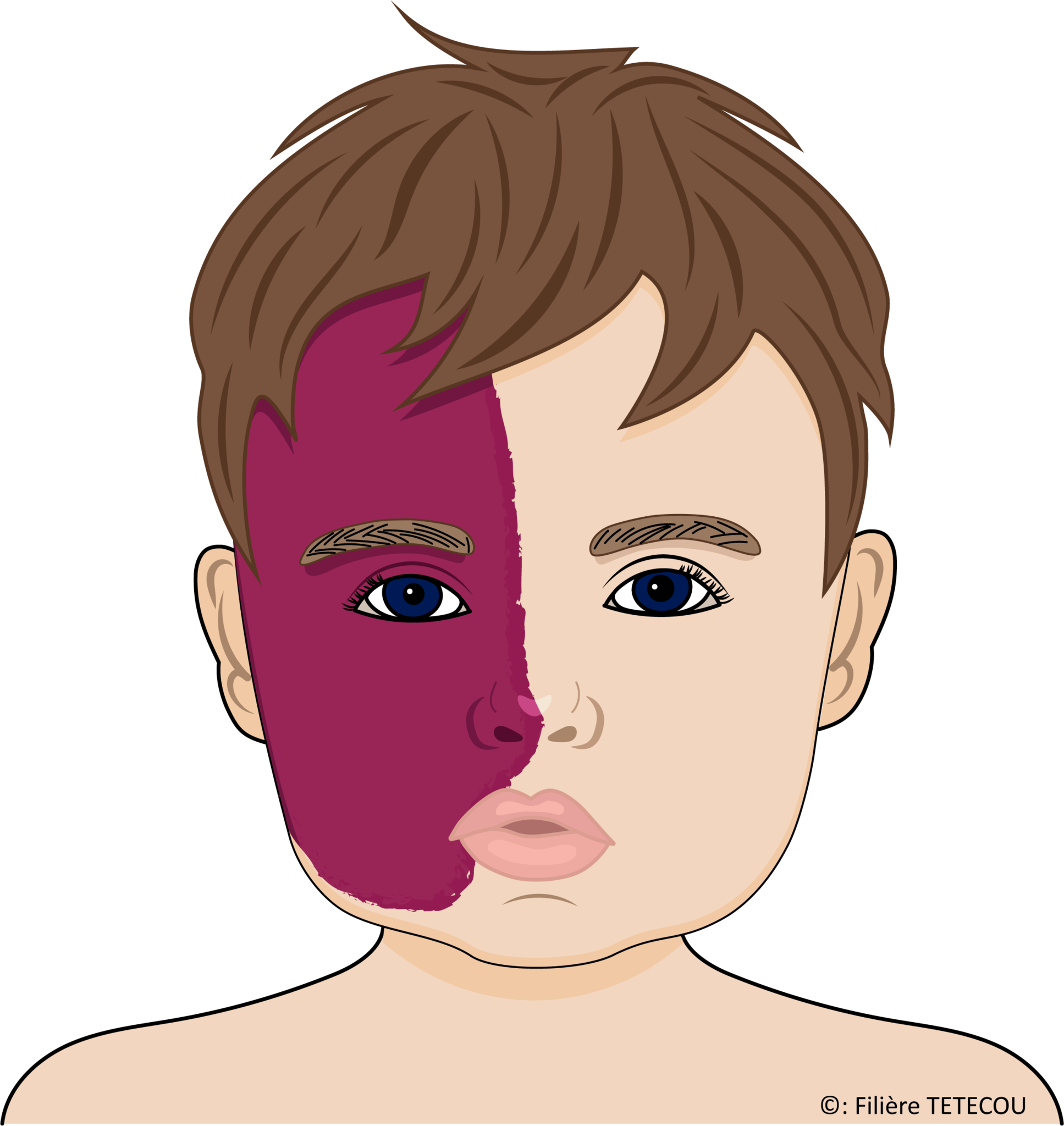 Syndrome de Sturge Weber Syndrome de Sturge Weber