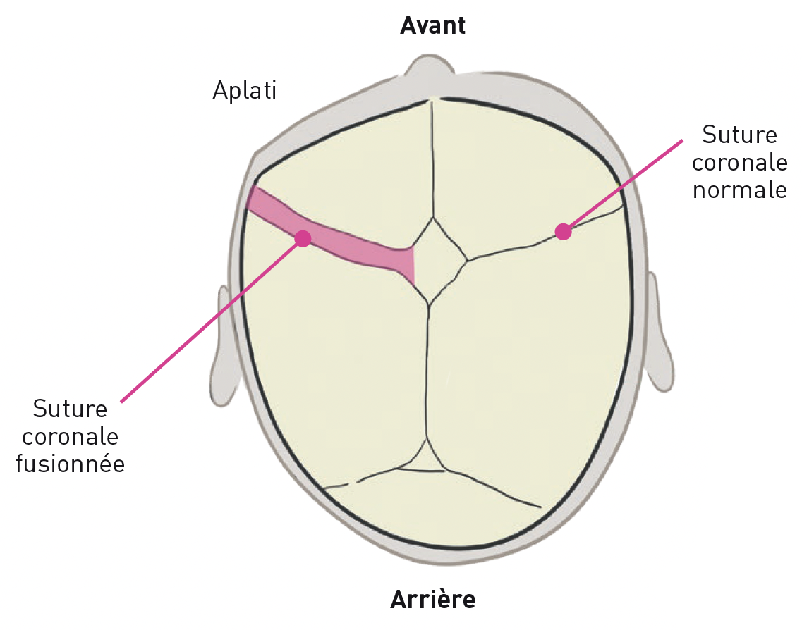 Livret CRANIOST Plagiocéphalie coronale blanc