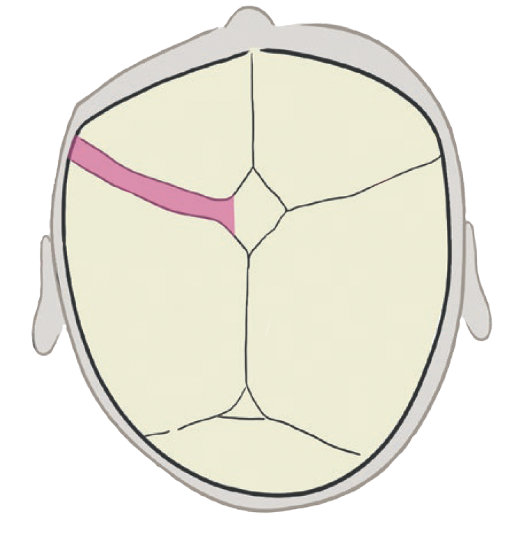 Livret CRANIOST Plagiocéphalie coronale transparent