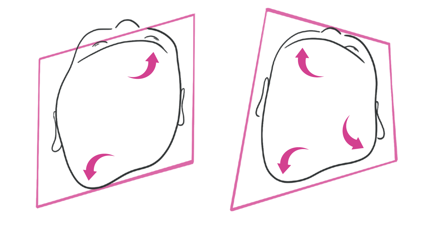 Livret CRANIOST Plagiocéphalie lambdoide#positionnelle