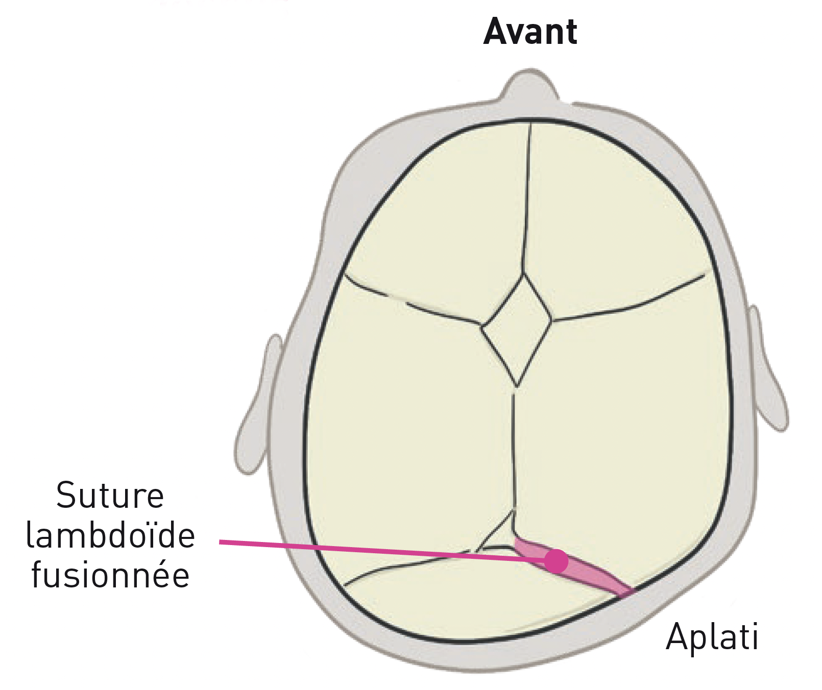 Livret CRANIOST Plagiocéphalie postérieure blanc