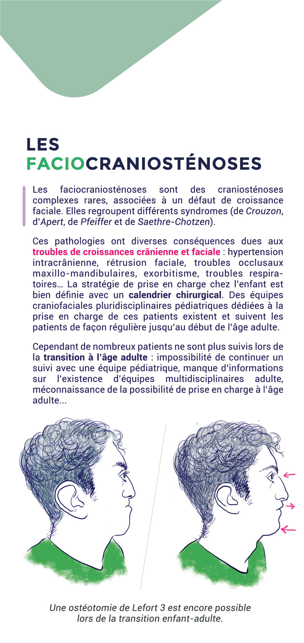 Maquette #craniostenose p2