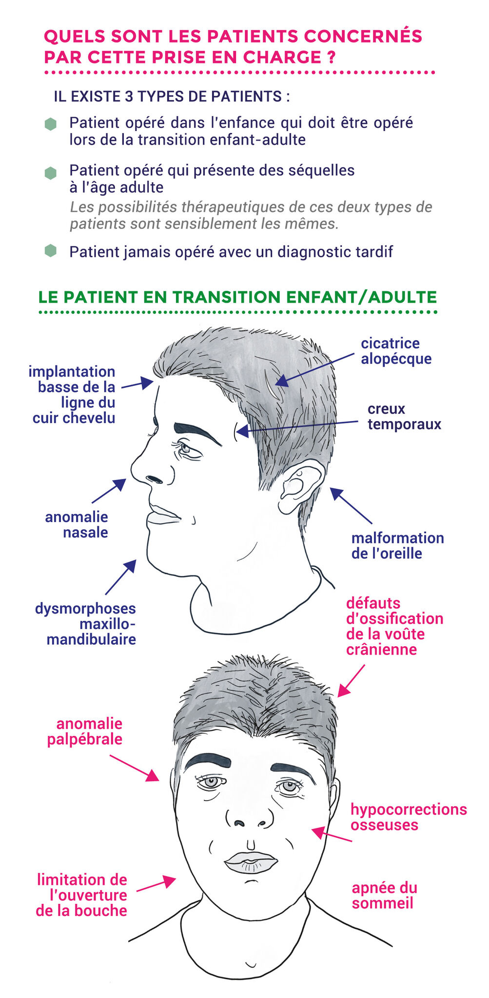 Maquette #craniostenose p3